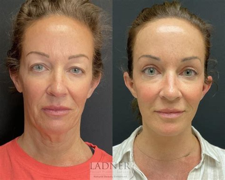 Did Amy Poehler Get Facelift Surgery? Before And After Photos