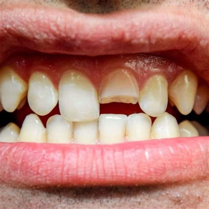 Emily Bustamante’s Front Teeth Was Damaged When Husband Fabolous Punched Her Face Seven Times