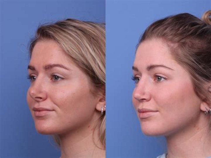 Ethan Slater Nose Job: Before and After Photos