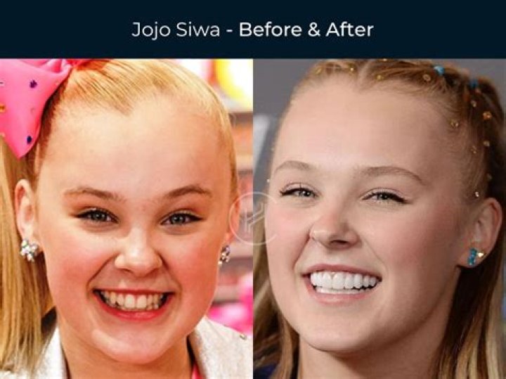 Millie Bright Teeth Before And After: Has She Used Braces?