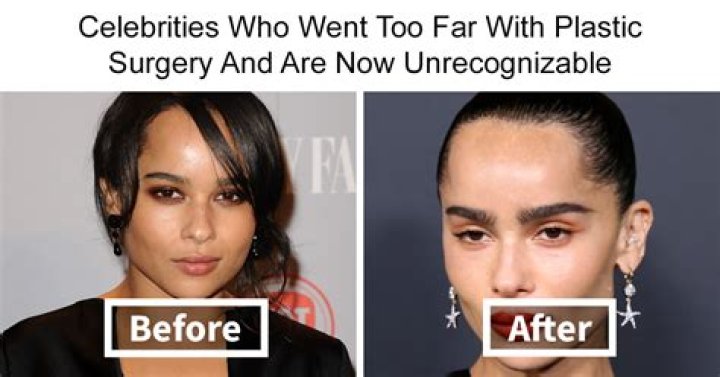 Reality Star Hazel-E Has Suffered Serious Complications From Plastic Surgery